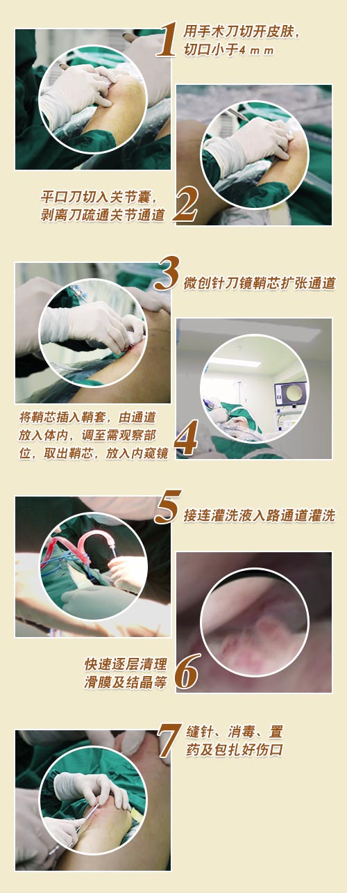 贵阳强直医院针刀镜技术 贵阳强直医院针刀镜技术