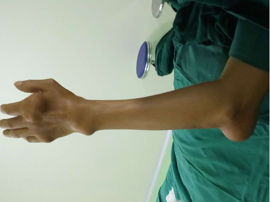 贵阳强直医院采用先进针刀镜技术帮助痛风患者取出重达一斤的痛风石！