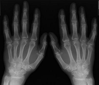 遗传类风湿性关节炎差点拖垮了这个年轻人 遗传类风湿性关节炎差点拖垮了这个年轻人