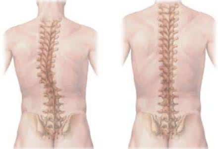 强直性脊柱炎为什么经常性的反复发作？