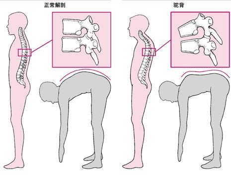 强直性脊柱炎真的会致使患者死亡吗？