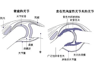 类风湿发作关节疼痛的厉害就老是躺着？这可不行！