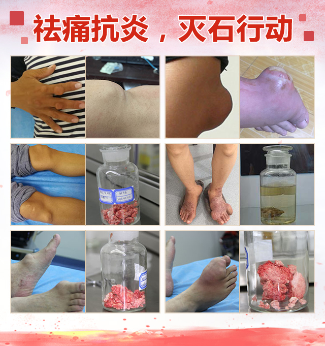 祛痛抗炎,灭石行动 祛痛抗炎,灭石行动.jpg