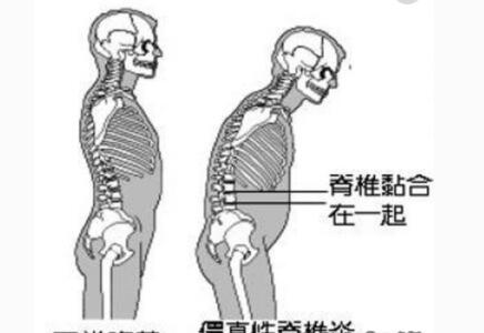 贵阳强直性脊柱炎医院：强直性脊柱炎怎么回事呢