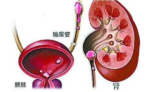 强直性脊柱炎有哪些禁忌?不要错过最好的治疗时间