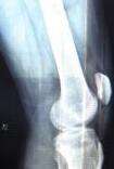 贵阳风湿专科医院建议膝关节滑膜炎需休息.jpg