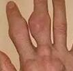 贵阳类风湿专科医院:风湿手指关节痛怎么治,平时疼痛如何调养