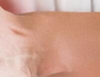 手指麻僵硬,蜂蜇疗法可以用来治疗类风湿关节炎吗