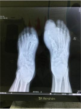 DR影像显示双足跖趾关节骨质严重被破坏